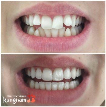Cải thiện tình trạng lệch khớp cắn do răng mọc sai lệch