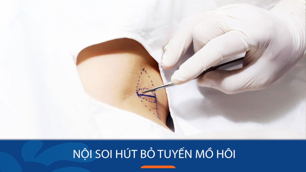 Nội soi hút bỏ tuyến mồ hôi: Những điều nên biết
