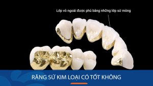 Răng sứ kim loại có tốt không? Cách để có nụ cười đẹp