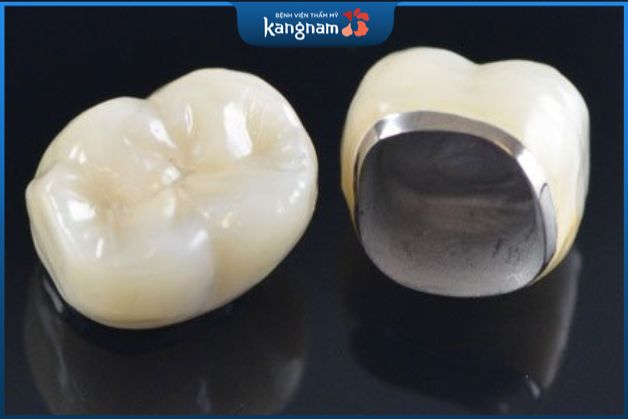 Răng sứ kim loại là dòng răng sứ xuất hiện đầu tiên trong ngành trồng răng sứ thẩm mỹ