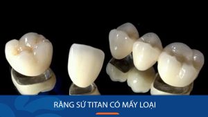 Răng sứ titan có mấy loại? 5 Điều cần biết