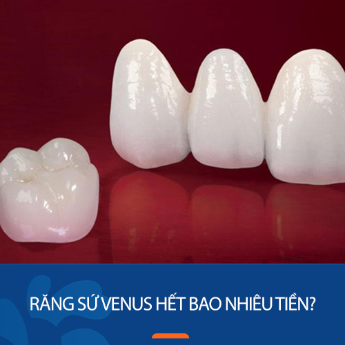 Răng sứ Venus hết bao nhiêu tiền? Các yếu tố ảnh hưởng tới giá