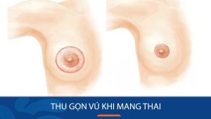 Thu gọn vú khi mang thai – Sở hữu vòng 1 đẹp cân đối