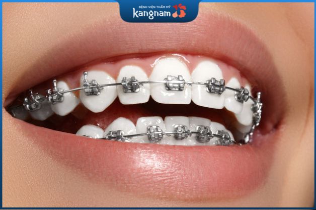 Niềng răng mắc cài kim loại thường có hiệu quả cao và chi phí thấp