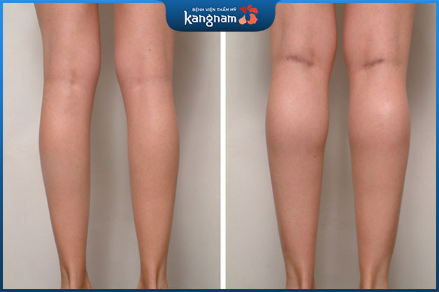 Khách hàng cấy mỡ bắp chân giúp cơ thể cân đối hơn