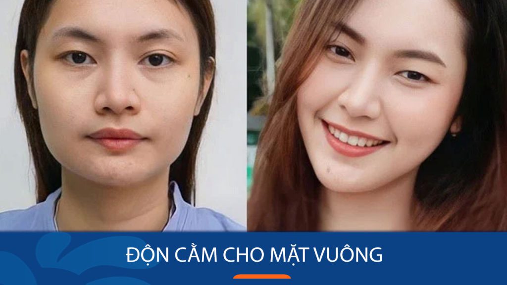 Độn cằm cho mặt vuông tại Kangnam – Uy tín, chất lượng, giá cả cạnh tranh