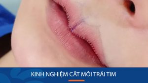 Kinh nghiệm cắt môi trái tim đẹp tự nhiên, không sẹo