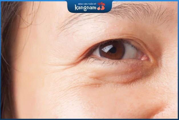 MÍ mắt sụp có thể do quá trình lão hóa xuất hiện da chùng, mỡ thừa