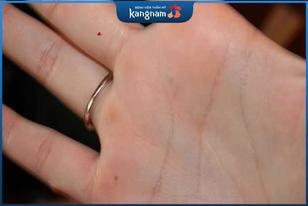 Nốt ruồi son trong lòng bàn tay thường có màu sắc đỏ tươi hoặc đỏ hồng