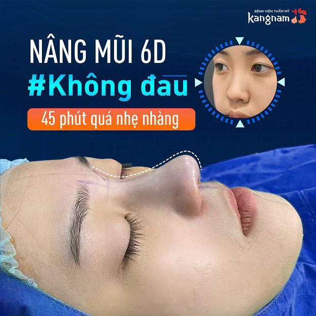 Nâng mũi 6D Kangnam không đau, không biến chứng
