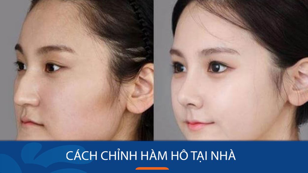 Cách chỉnh hàm hô tại nhà hiệu quả bất ngờ ngoài mong đợi
