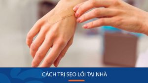 14 Cách Trị Sẹo Lồi Tại Nhà Hiệu Quả Nhất 2024 (Đã Kiểm Chứng)