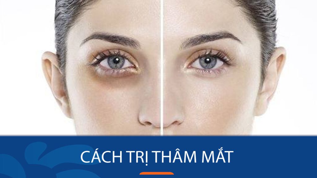 10 Cách trị thâm mắt hiệu quả – “Xóa sổ” quầng thâm