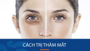 17 Cách trị thâm mắt hiệu quả – “Xóa sổ” quầng thâm