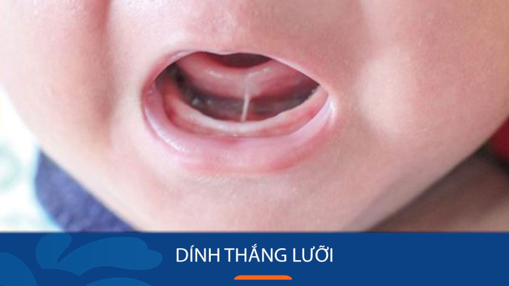 Dính thắng lưỡi là gì? Cảnh báo 5 hệ lụy và Cách khắc phục
