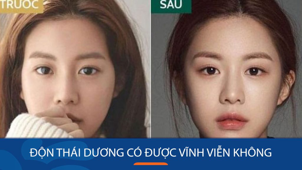 Độn thái dương có được vĩnh viễn không? – Bệnh viện Kangnam