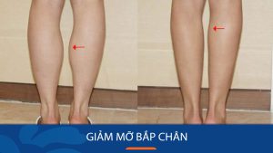 15 Cách giảm mỡ bắp chân cấp tốc bằng những bài tập hiệu quả