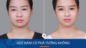 Gọt hàm có phá tướng không? Góc nhìn phong thủy và giải pháp thẩm mỹ an toàn