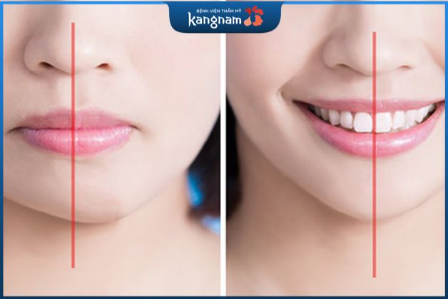 Khuôn mặt bị lệch lạc không thể cải thiện toàn diện bằng phương pháp niềng răng