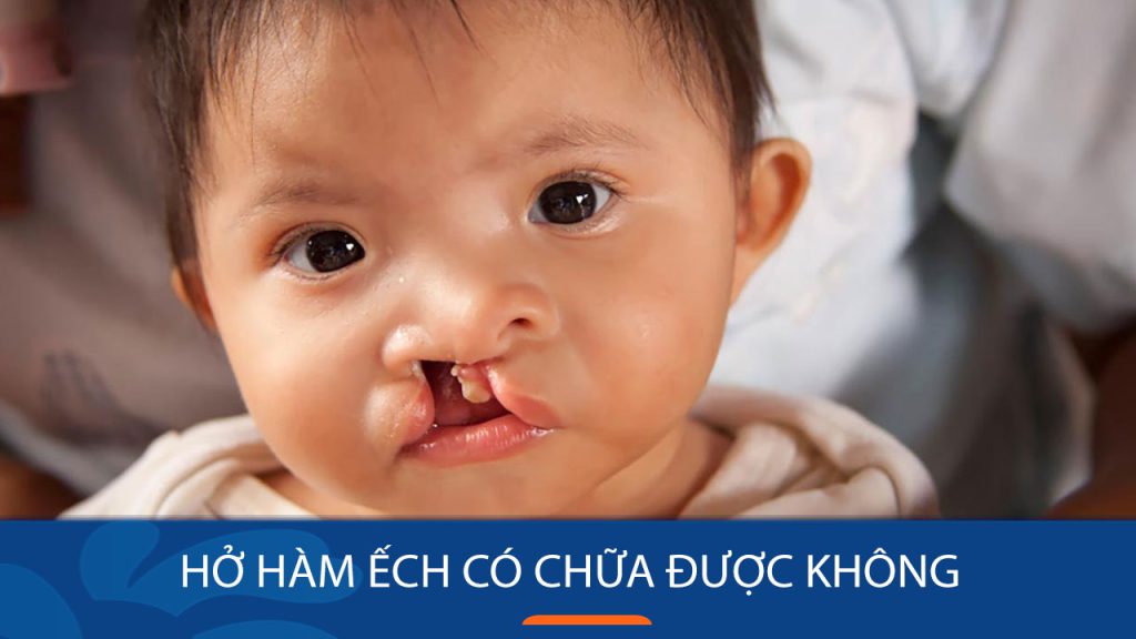 Hở hàm ếch có chữa được không? Không phẫu thuật sai thời điểm