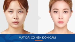 Mặt dài có nên độn cằm? Giải đáp thắc mắc từ chuyên gia