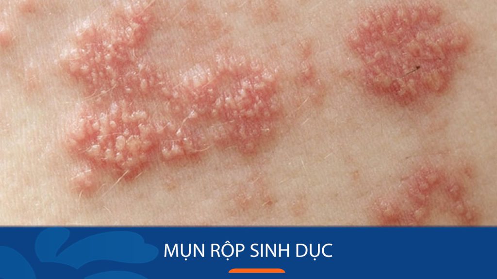 Mụn rộp sinh dục: Giải đáp mọi thắc mắc về căn bệnh nhạy cảm này