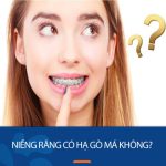 Niềng răng có hạ gò má không? Những thay đổi sau khi niềng răng