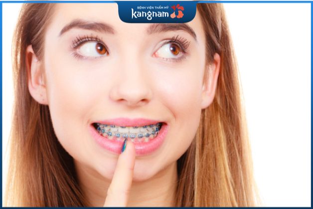 quá trình niềng răng có thể dẫn đến hạ gò má trong một số trường hợp cụ thể