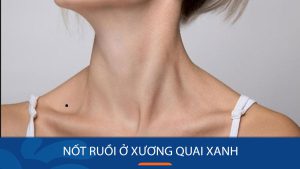 Nốt ruồi xương quai xanh: Tìm hiểu ngay ý nghĩa vận mệnh Nam, Nữ