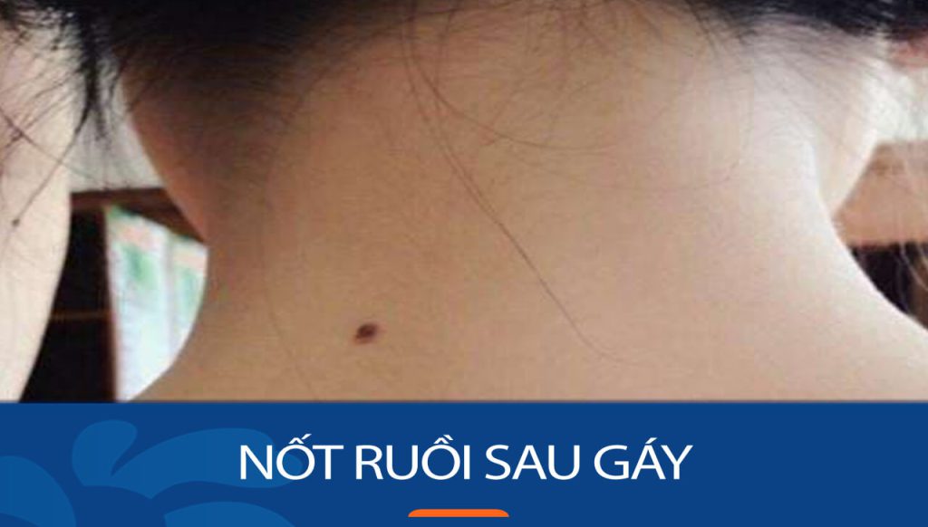 Nốt ruồi sau gáy: Hé lộ bí ẩn Đàn ông phất lên, phụ nữ giàu sang?