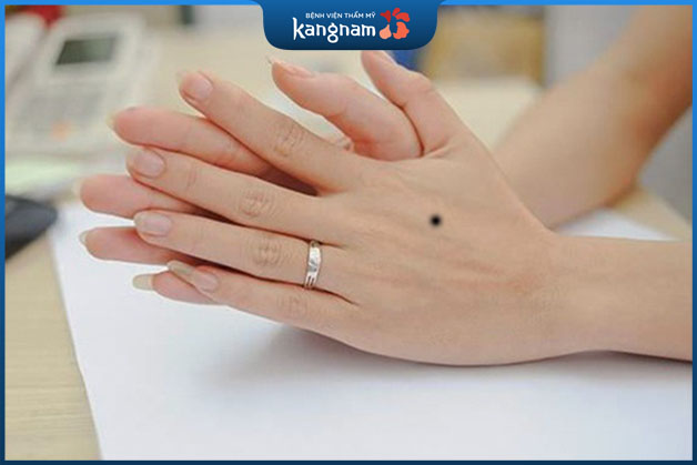 Nốt loài ruồi bên trên mu bàn tay là đảm bảo chất lượng hoặc xấu xa còn tùy thuộc vào nhiều yếu đuối tố