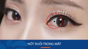 Nốt Ruồi Trên Mắt Trái, Phải: Giải Mã Bí Ẩn Vận Mệnh, Tính Cách