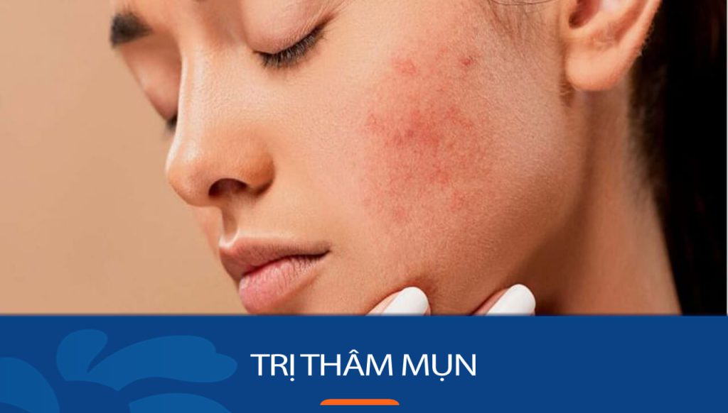 20+ Cách Trị Thâm Mụn Cấp Tốc Tại Nhà – Bí Quyết Cho Làn Da Sáng Mịn