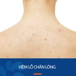 Viêm lỗ chân lông: 12 Nguyên nhân và Cách khắc phục