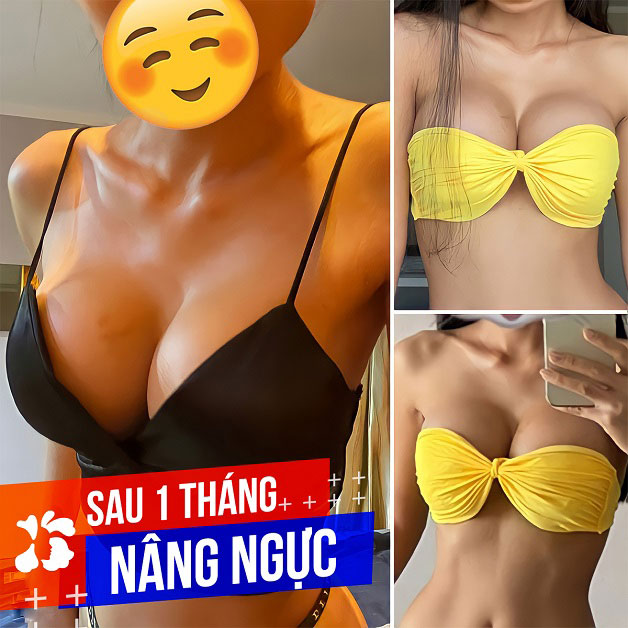 Sau 1 tháng nâng ngực, chị khách đã hồi phục nhanh chóng, không còn sưng đau