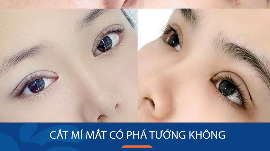 Cắt mí mắt có thay đổi vận mệnh không? Thông tin hữu ích