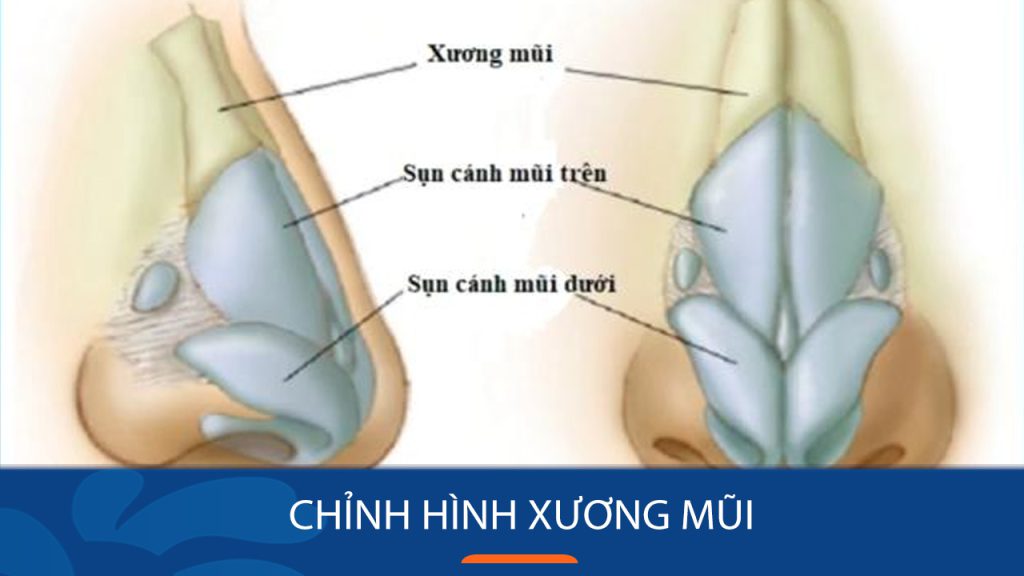 Chỉnh hình xương mũi: 2 Giải pháp khắc phục hoàn hảo