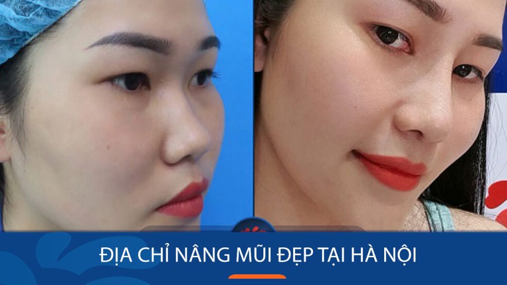 Địa chỉ nâng mũi uy tín tại Hà Nội? Gợi ý 5 địa chỉ uy tín nhất