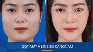 Gọt mặt V line 3D Kangnam – Sở hữu gương mặt thon gọn và thanh tú
