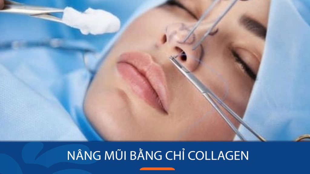 Nâng mũi bằng chỉ Collagen: Ưu, Nhược điểm và Thời gian