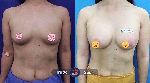 Sự thay đổi ngoạn mục trước và sau khi nâng ngực