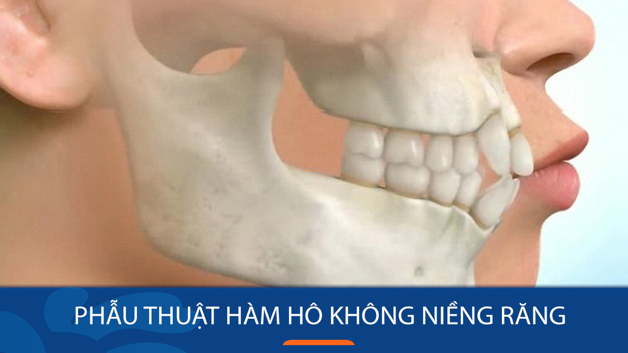 Phẫu thuật hàm hô không niềng răng