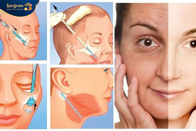 Căng da mặt là biện pháp kéo căng vùng da chảy xệ, chùng nhão ở người bị lão hóa nặng