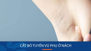 Cắt bỏ tuyến vú phụ ở nách –  Loại bỏ hoàn toàn, tự tin tỏa sáng!