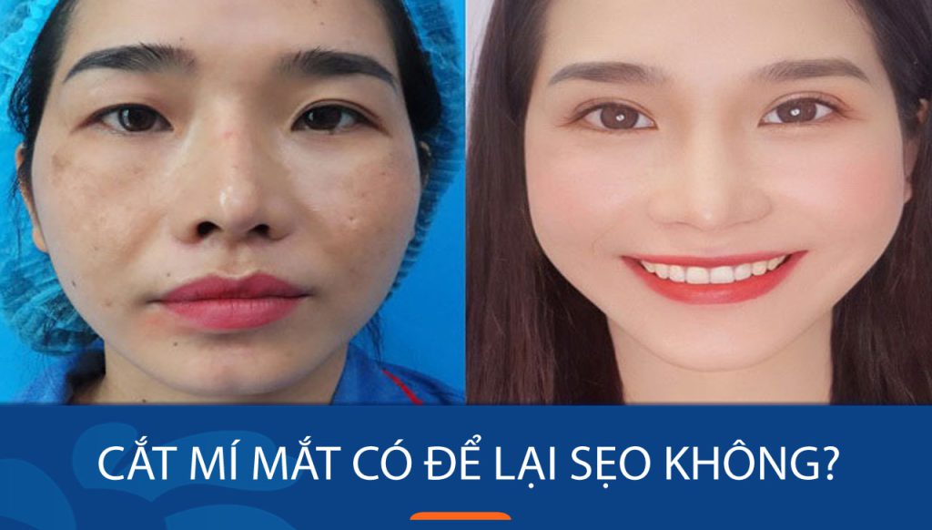 Cắt mí mắt có để lại sẹo không? Những lưu ý quan trọng