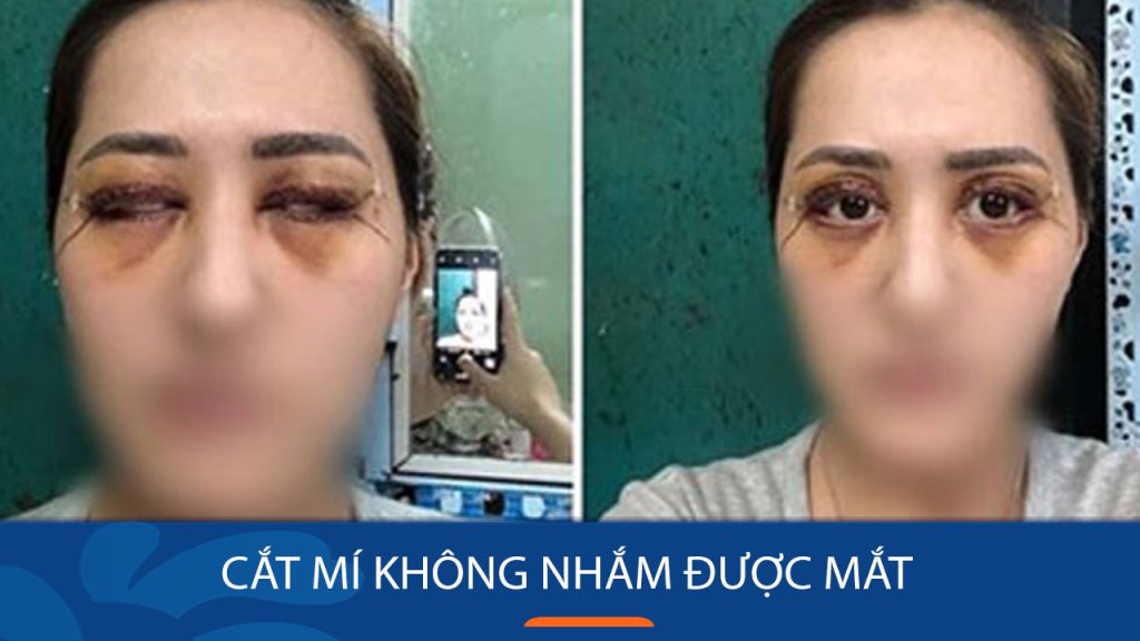 Cắt mí không nhắm được mắt: Nguyên nhân và cách khắc phục