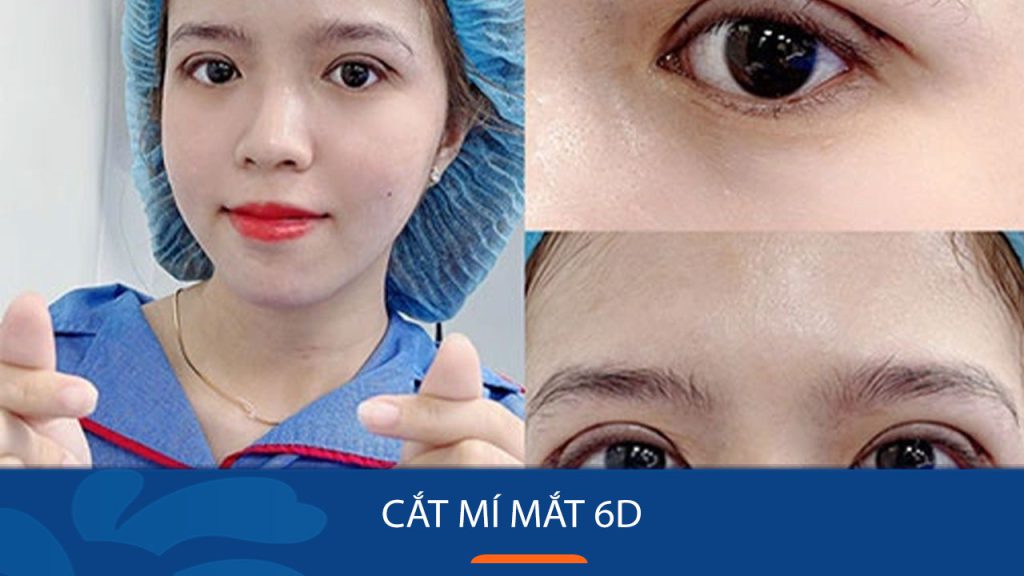 Cắt mí mắt 6D – Cắt mí tàng hình, giảm tối đa sưng đau