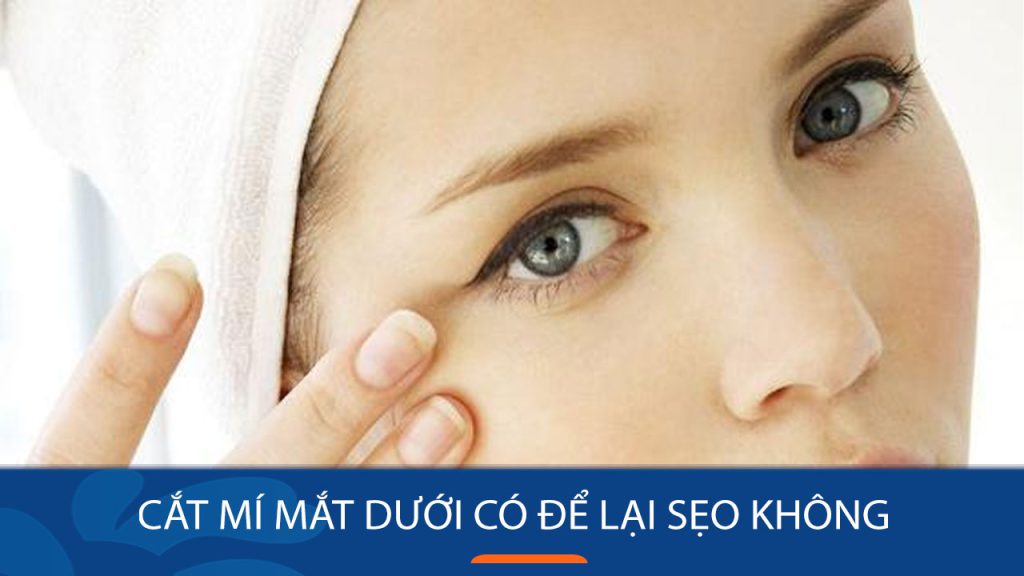 Cắt mí mắt dưới có để lại sẹo không? 4 TIPS ngừa sẹo hiệu quả