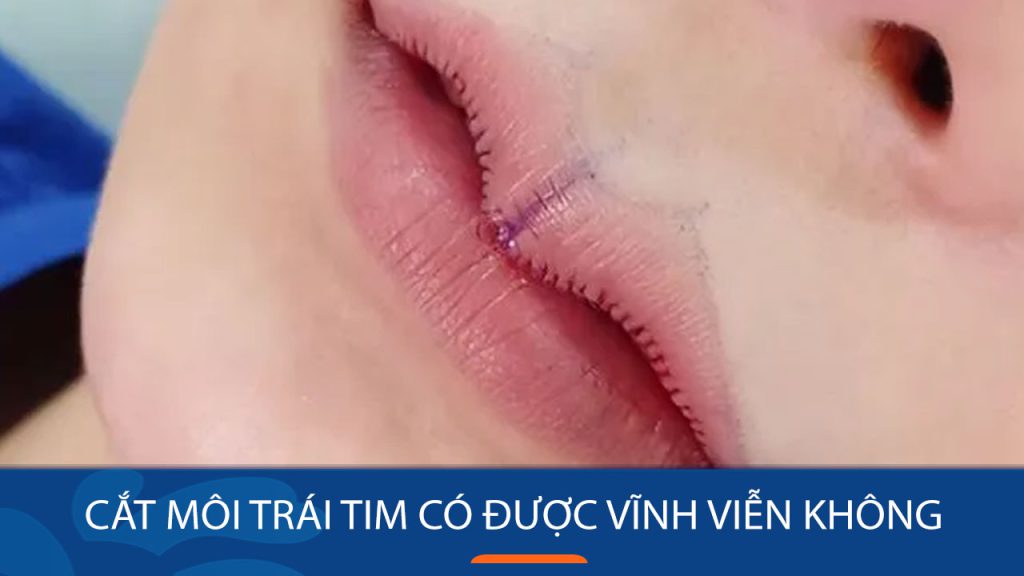 Cắt môi trái tim có vĩnh viễn không? Giải đáp thắc mắc từ chuyên gia