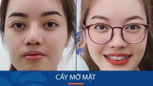Cấy mỡ mặt – Sự lựa chọn hoàn hảo cho làn da xinh đẹp